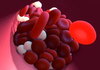 an illustration of a blood vessel with clumped-together blood cells inside